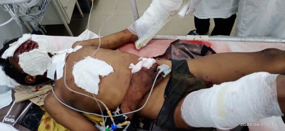 Sariakela news सरायकेला में बम फटने से दो बच्चे झुलसे, एमजीएम अस्पताल में चल रहा इलाज… | Vananchal 24TV Live